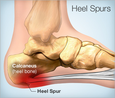 Heel spur