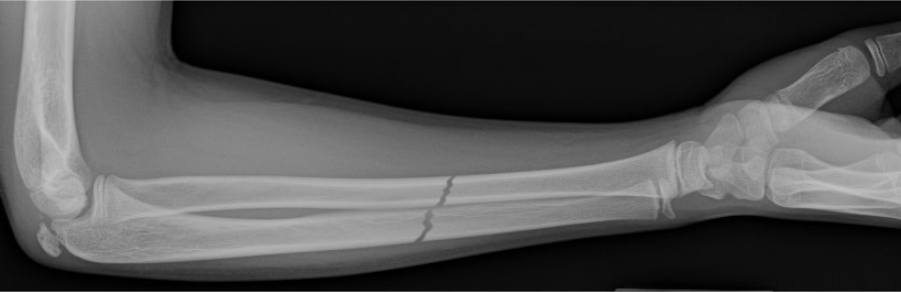 Fractured forearm